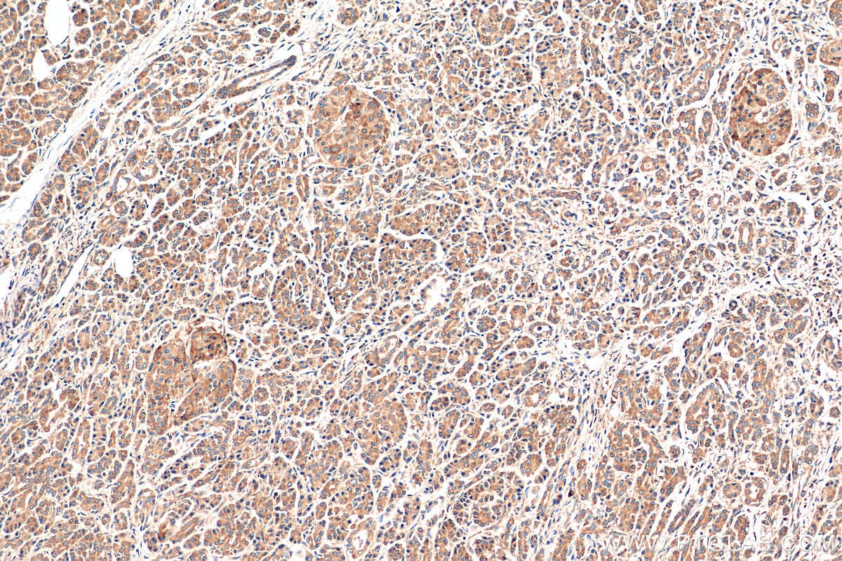 Immunohistochemistry (IHC) staining of human pancreas cancer tissue using OXR1 Polyclonal antibody (13514-1-AP)