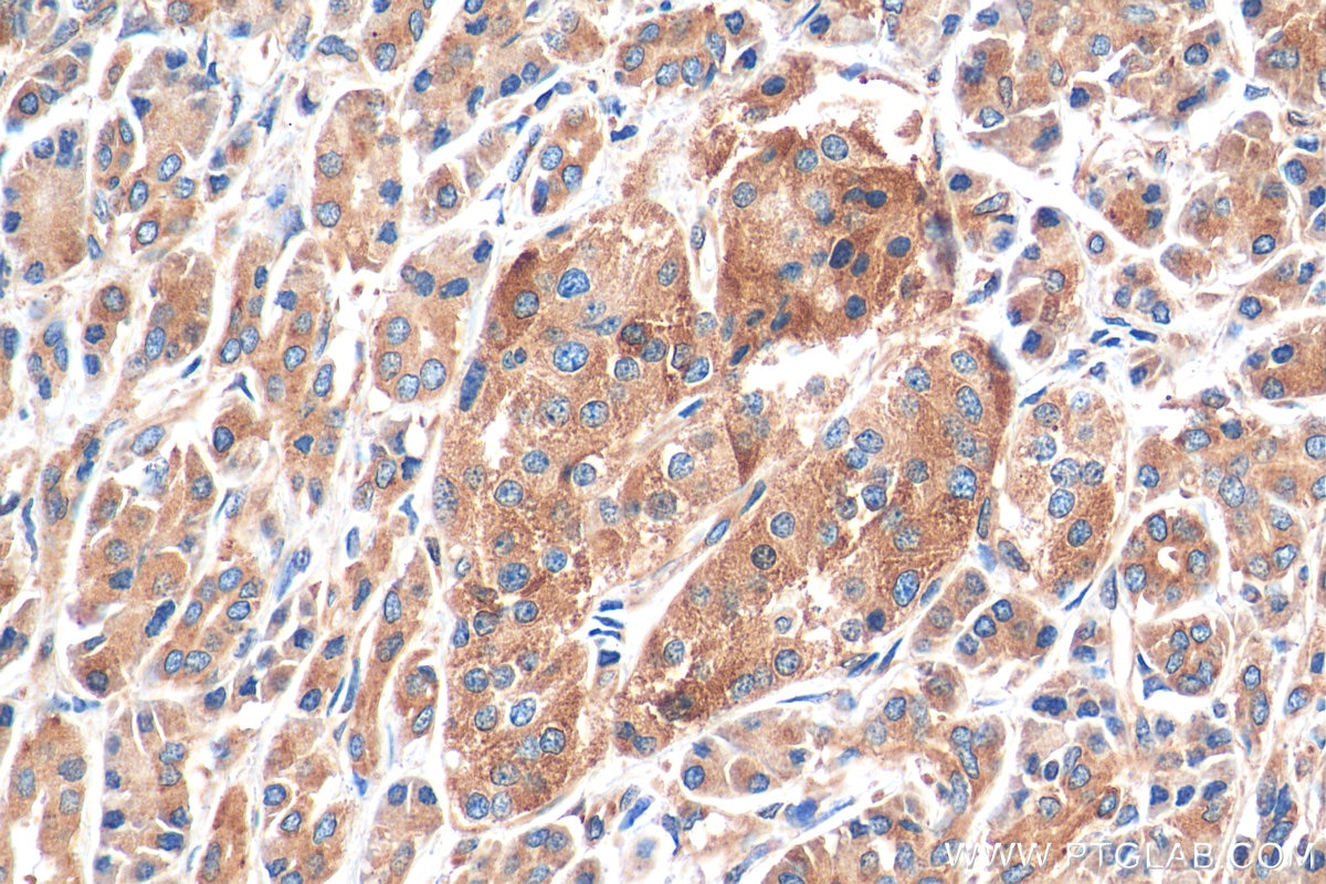 Immunohistochemistry (IHC) staining of human pancreas cancer tissue using OXR1 Polyclonal antibody (13514-1-AP)