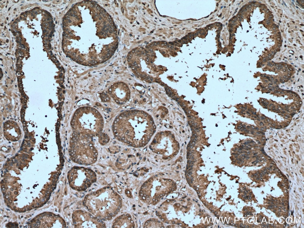 Immunohistochemistry (IHC) staining of human prostate cancer tissue using OXSR1 Polyclonal antibody (15611-1-AP)