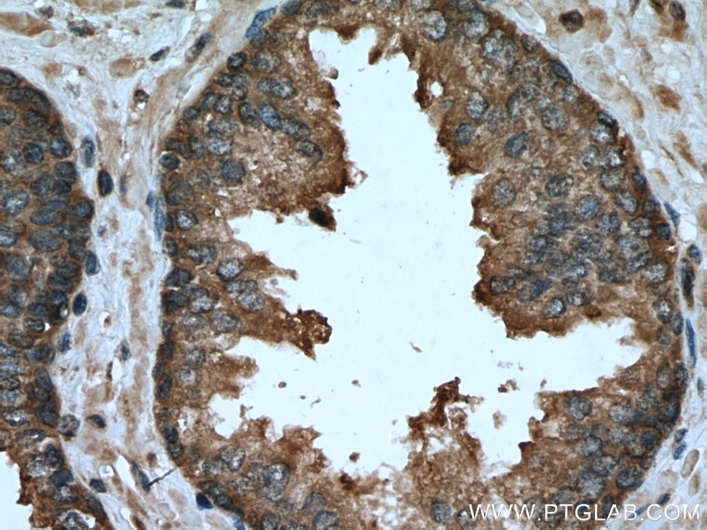 Immunohistochemistry (IHC) staining of human prostate cancer tissue using OXSR1 Polyclonal antibody (15611-1-AP)