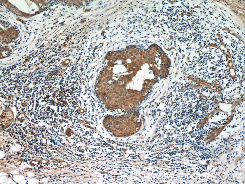 IHC staining of human breast cancer using 23045-1-AP