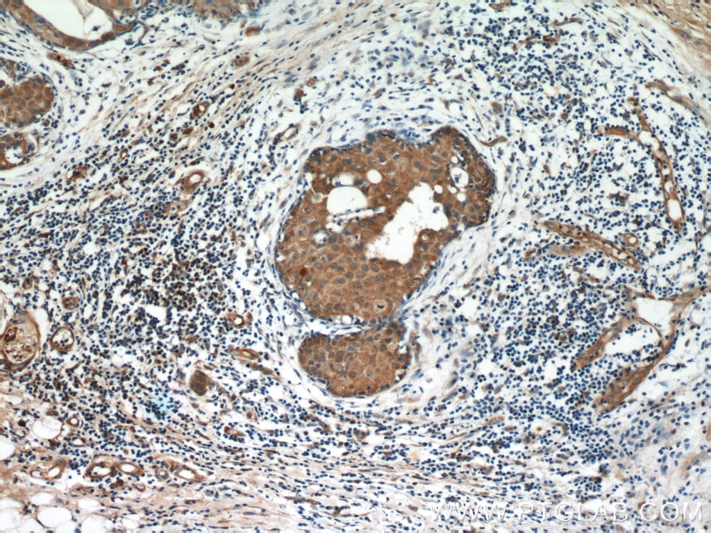 Immunohistochemistry (IHC) staining of human breast cancer tissue using OXTR Polyclonal antibody (23045-1-AP)