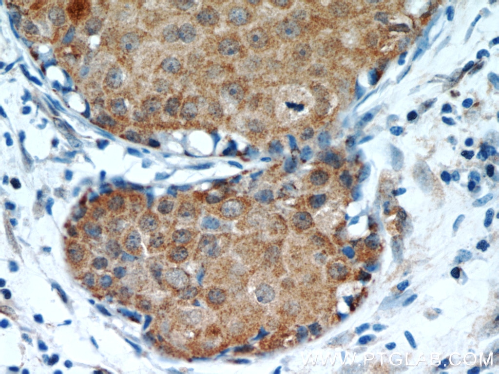 Immunohistochemistry (IHC) staining of human breast cancer tissue using OXTR Polyclonal antibody (23045-1-AP)