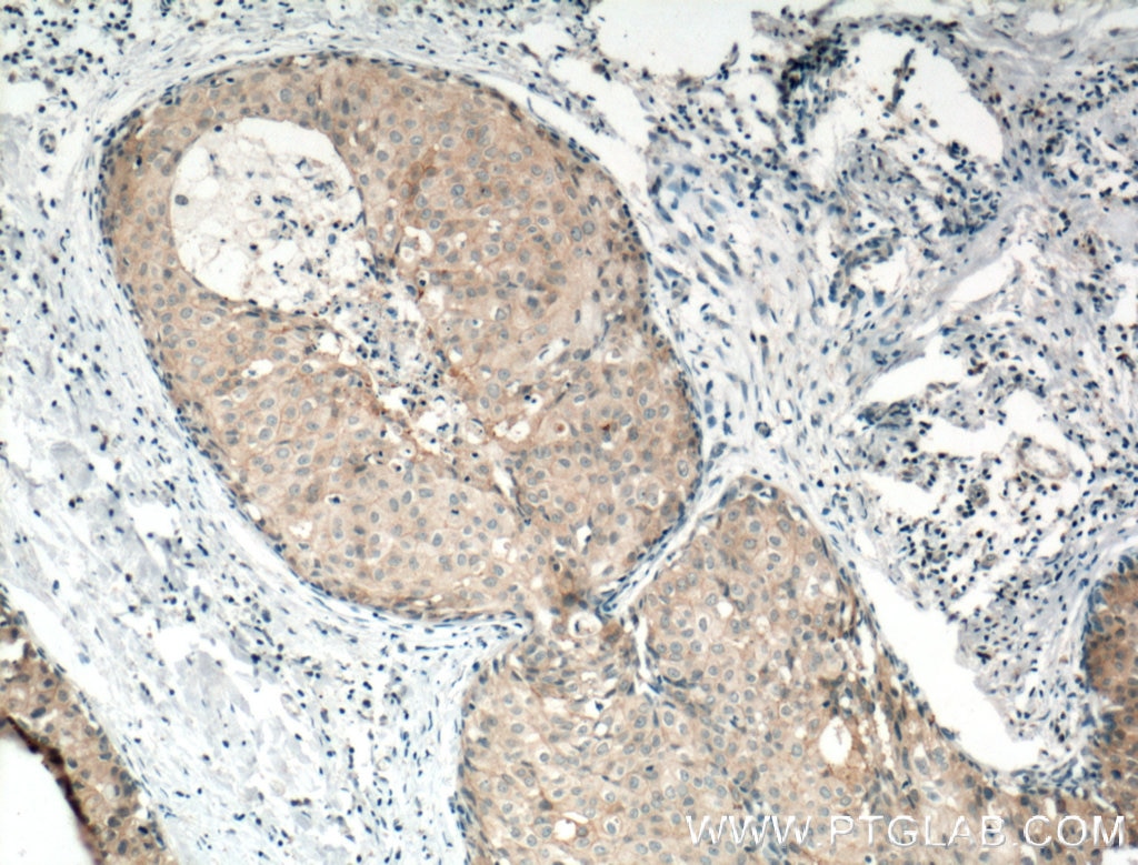 Immunohistochemistry (IHC) staining of human breast cancer tissue using Occludin Polyclonal antibody (27260-1-AP)
