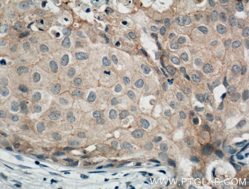 Immunohistochemistry (IHC) staining of human breast cancer tissue using Occludin Polyclonal antibody (27260-1-AP)