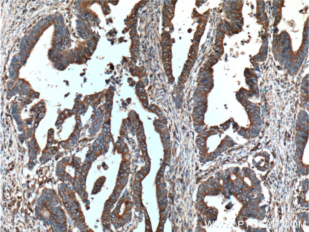 Immunohistochemistry (IHC) staining of human colon cancer tissue using Occludin Monoclonal antibody (66378-1-Ig)