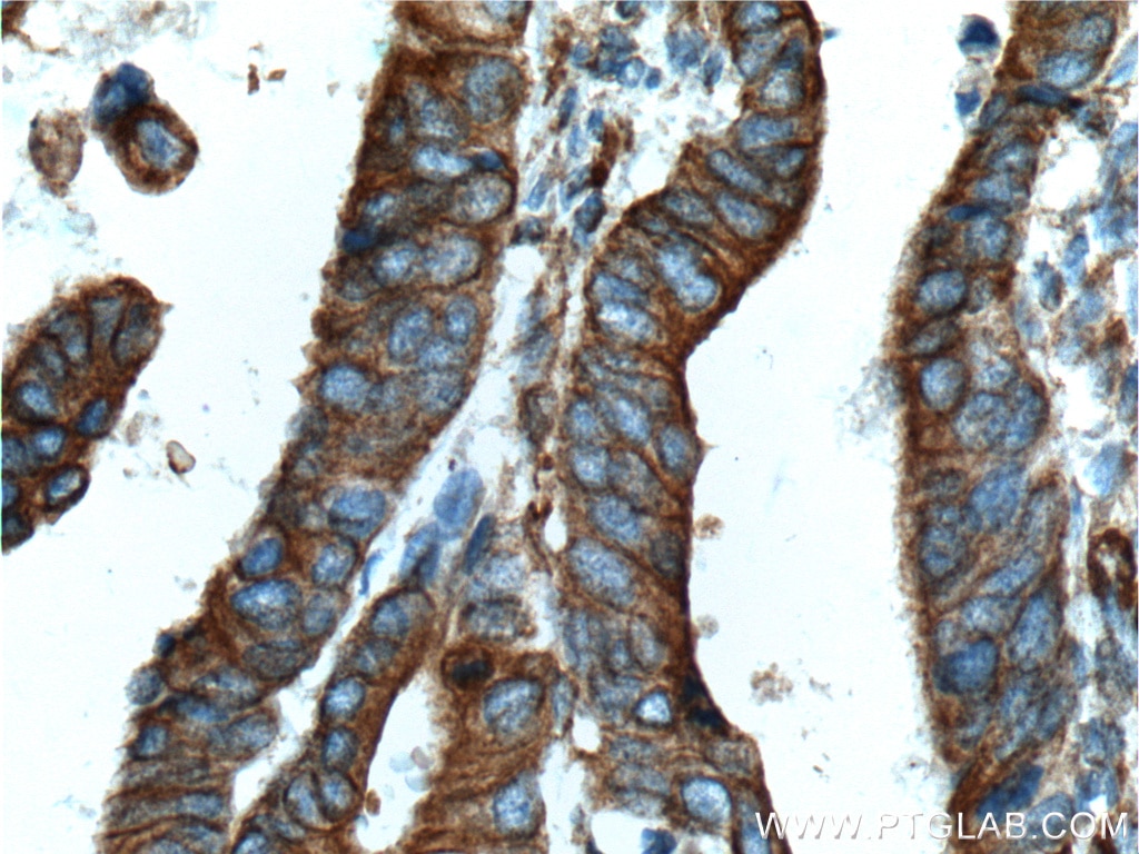 Immunohistochemistry (IHC) staining of human colon cancer tissue using Occludin Monoclonal antibody (66378-1-Ig)