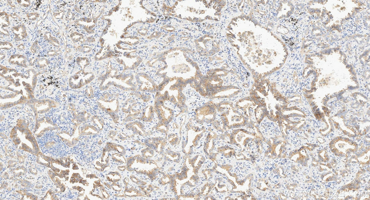 Immunohistochemistry (IHC) staining of human lung cancer tissue using Occludin Monoclonal antibody (66378-1-Ig)