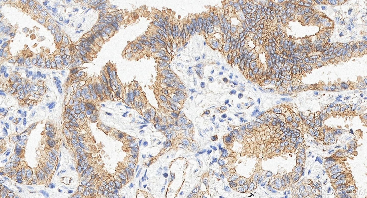 Immunohistochemistry (IHC) staining of human lung cancer tissue using Occludin Monoclonal antibody (66378-1-Ig)