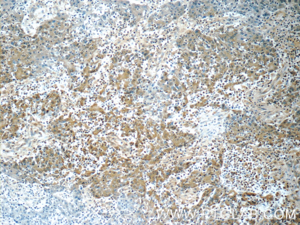 Immunohistochemistry (IHC) staining of human colon cancer tissue using ORAI1 Polyclonal antibody (14443-1-AP)