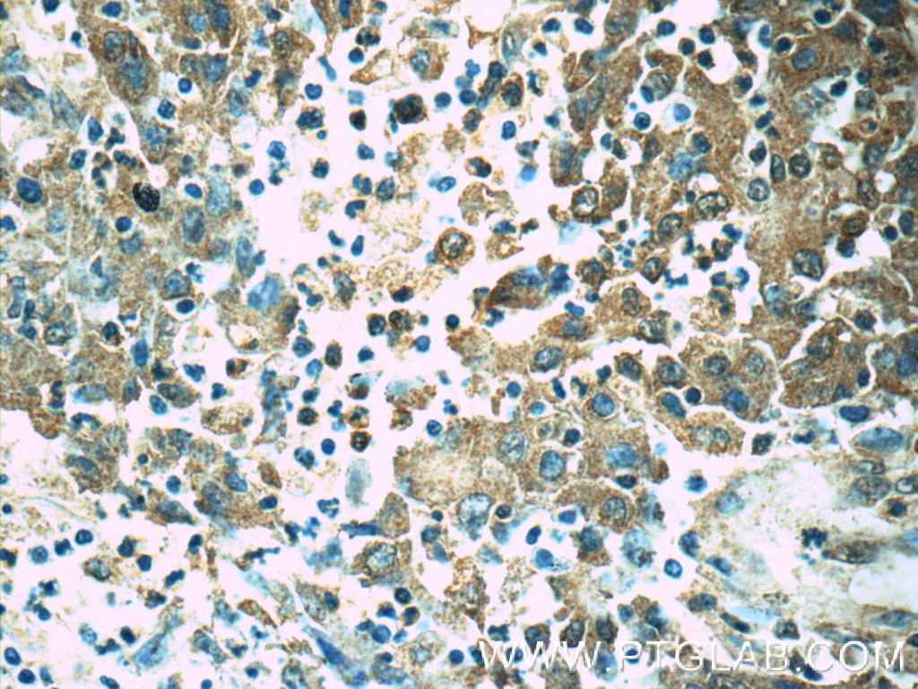 Immunohistochemistry (IHC) staining of human colon cancer tissue using ORAI1 Polyclonal antibody (14443-1-AP)