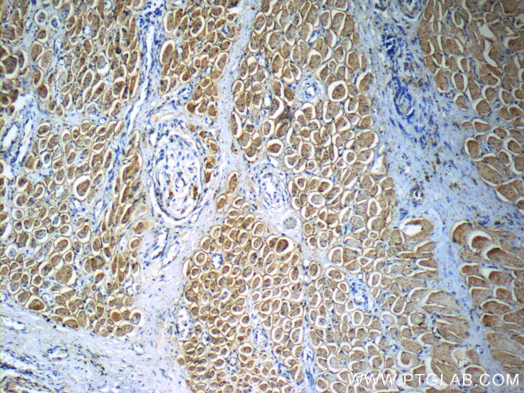 Immunohistochemistry (IHC) staining of human osteosarcoma tissue using Osteocalcin Polyclonal antibody (23418-1-AP)