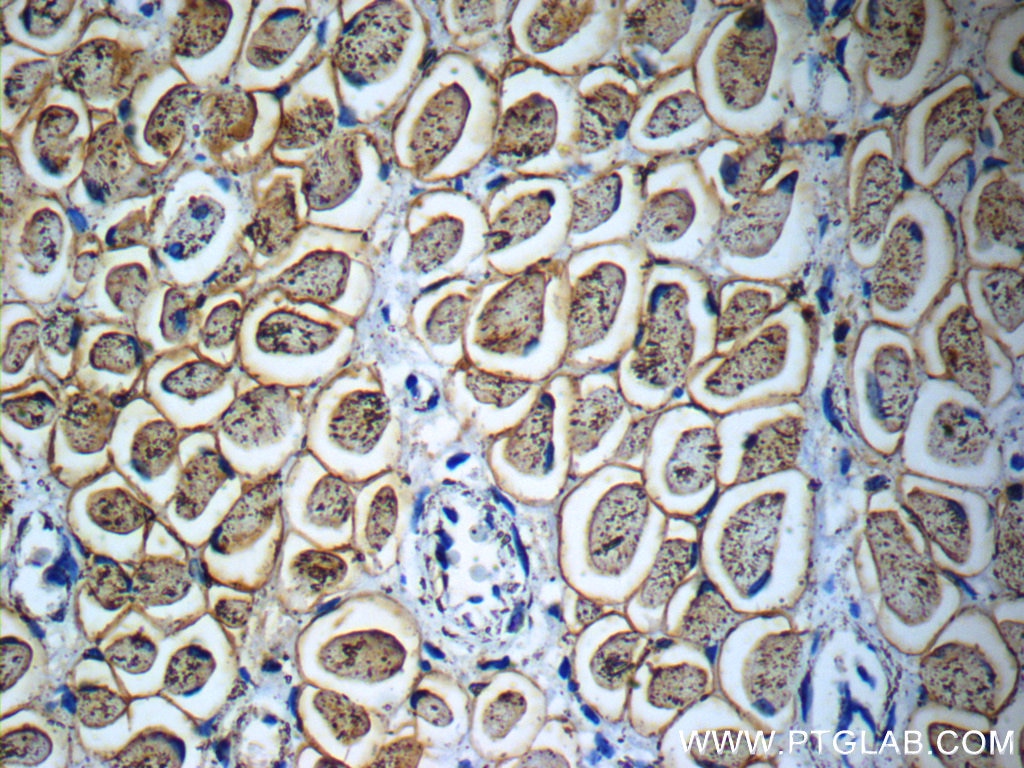 IHC staining of human osteosarcoma using 23418-1-AP