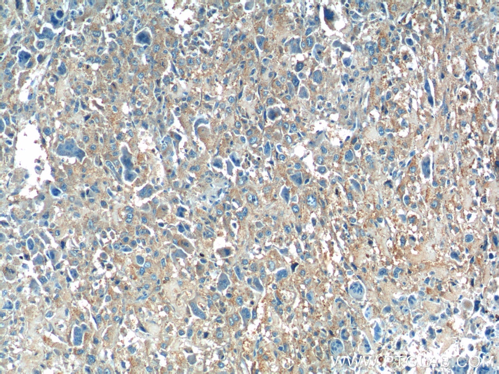 IHC staining of human osteosarcoma using 23418-1-AP