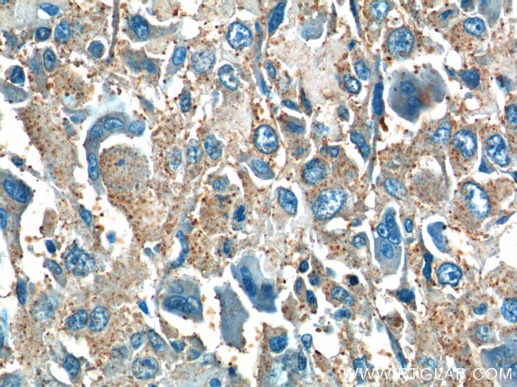 IHC staining of human osteosarcoma using 23418-1-AP