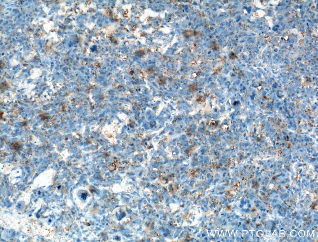 IHC staining of human osteosarcoma using 23418-1-AP