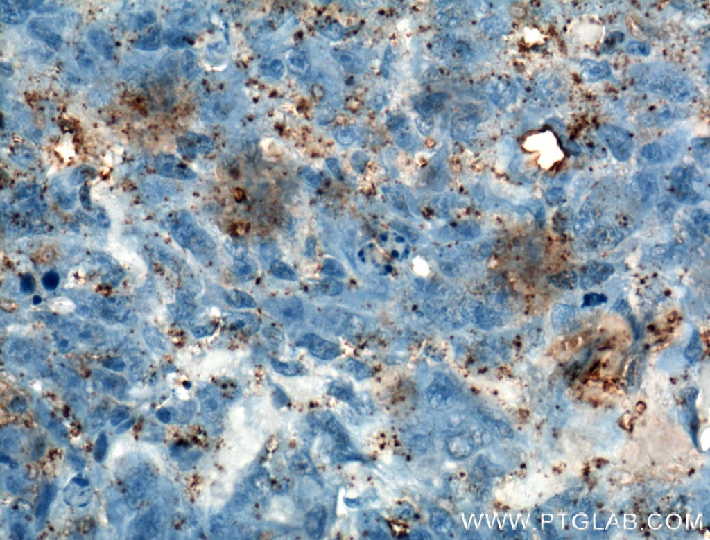 Immunohistochemistry (IHC) staining of human osteosarcoma tissue using Osteocalcin Polyclonal antibody (23418-1-AP)
