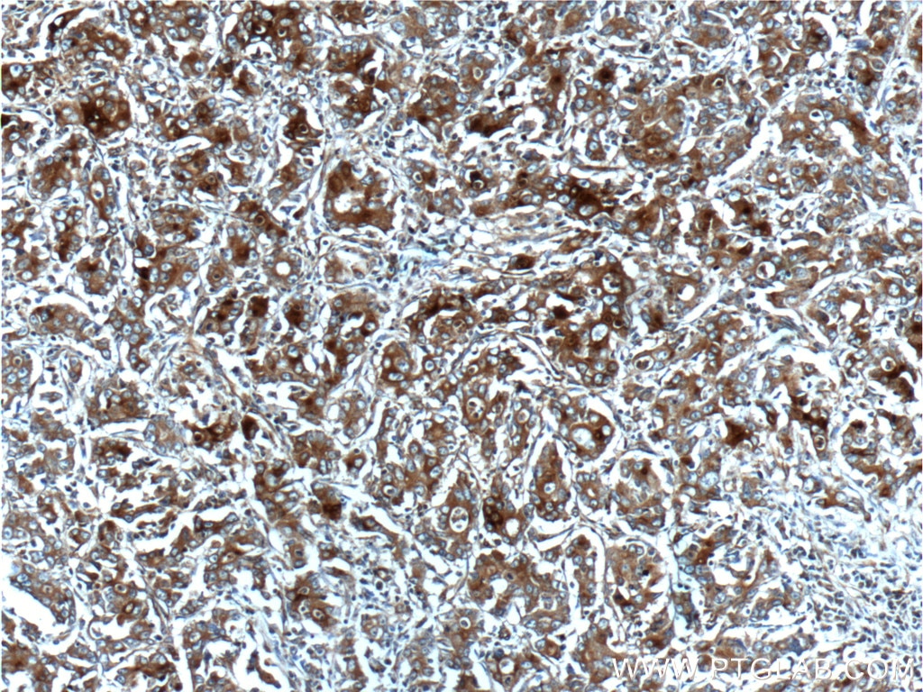 Immunohistochemistry (IHC) staining of human stomach cancer tissue using Osteopontin Polyclonal antibody (25715-1-AP)