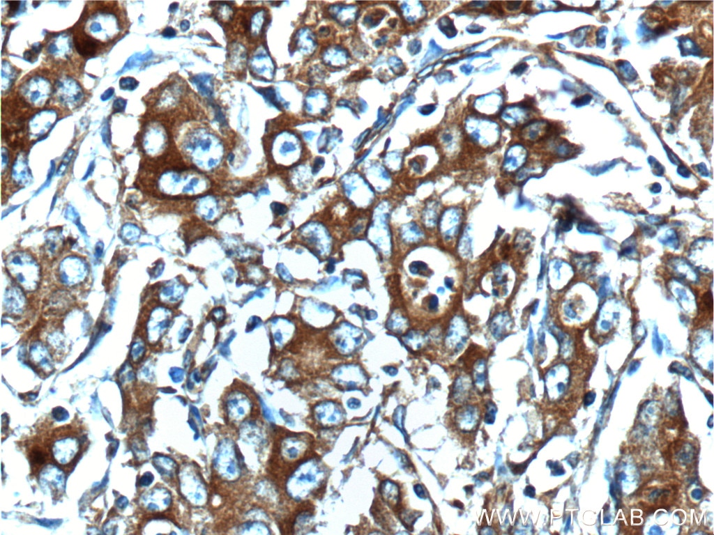 Immunohistochemistry (IHC) staining of human stomach cancer tissue using Osteopontin Polyclonal antibody (25715-1-AP)