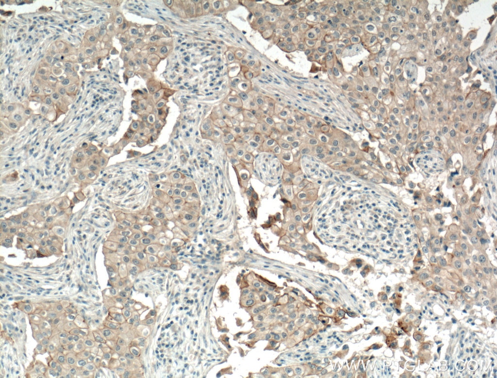 Immunohistochemistry (IHC) staining of human breast cancer tissue using Biotin-conjugated P-cadherin Polyclonal antibody (Biotin-13773)