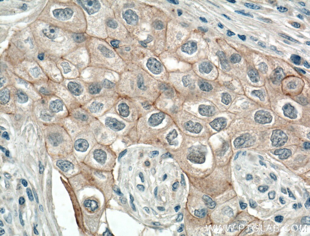 Immunohistochemistry (IHC) staining of human breast cancer tissue using Biotin-conjugated P-cadherin Polyclonal antibody (Biotin-13773)