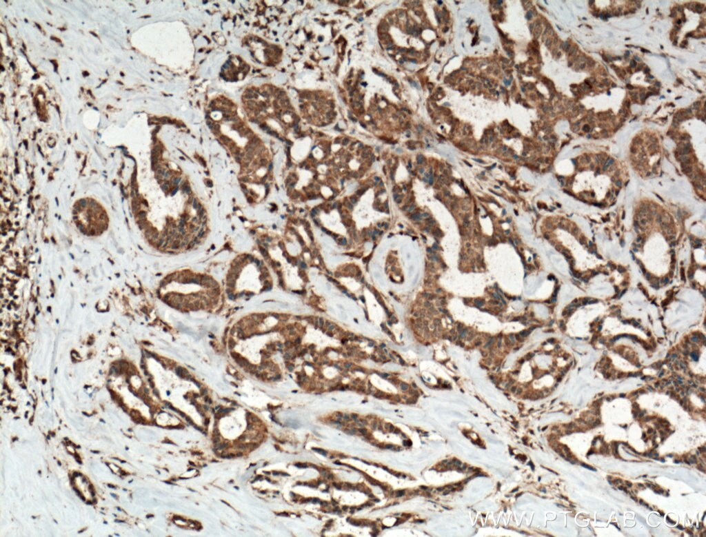 Immunohistochemistry (IHC) staining of human breast cancer tissue using PP11 Polyclonal antibody (18002-1-AP)