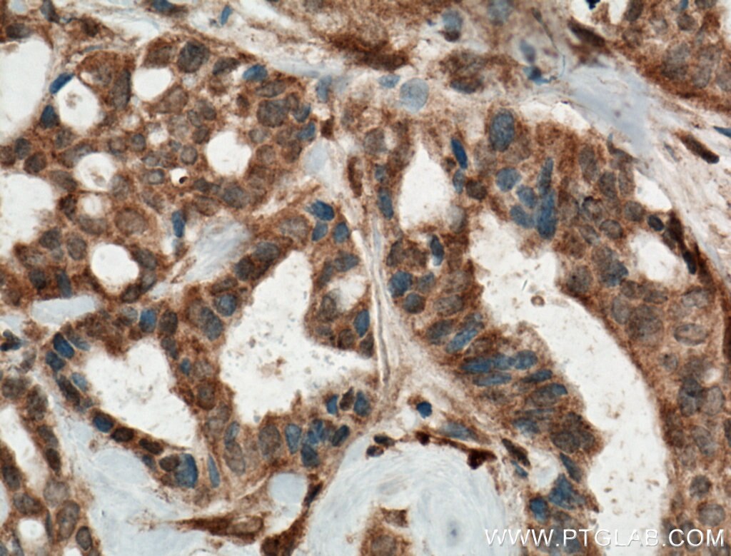 Immunohistochemistry (IHC) staining of human breast cancer tissue using PP11 Polyclonal antibody (18002-1-AP)