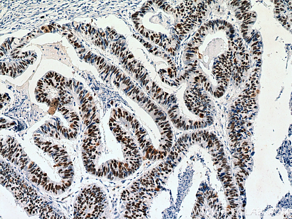 Immunohistochemistry (IHC) staining of human colon cancer tissue using NOLC1 Polyclonal antibody (11815-1-AP)