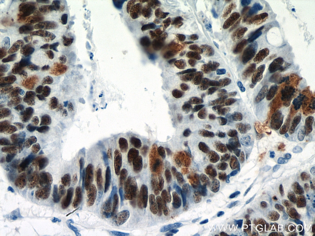 IHC staining of human colon cancer using 11815-1-AP