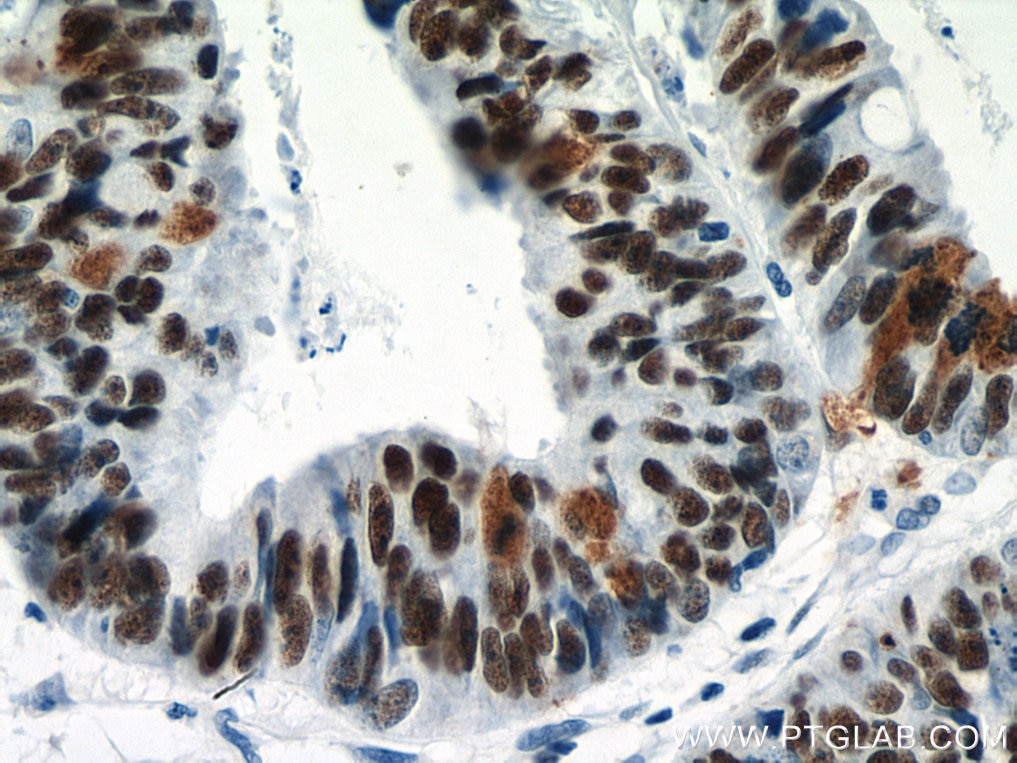 Immunohistochemistry (IHC) staining of human colon cancer tissue using NOLC1 Polyclonal antibody (11815-1-AP)