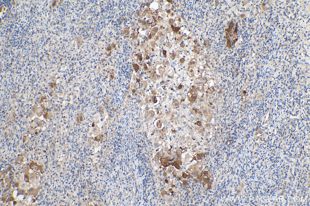 Immunohistochemistry (IHC) staining of human cervical cancer tissue using P16-INK4A Polyclonal antibody (10883-1-AP)
