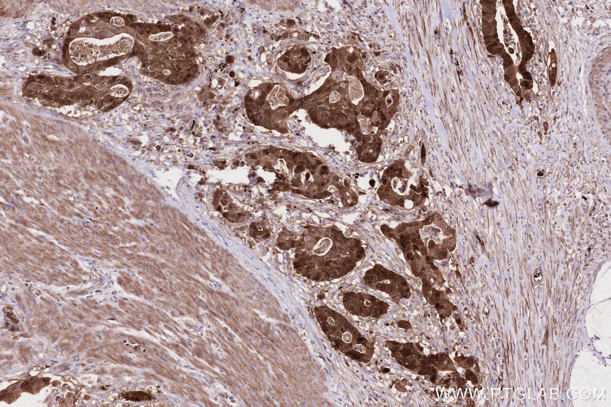 Immunohistochemistry (IHC) staining of human stomach cancer tissue using CDKN2A/P16-INK4A Polyclonal antibody (30519-1-AP)