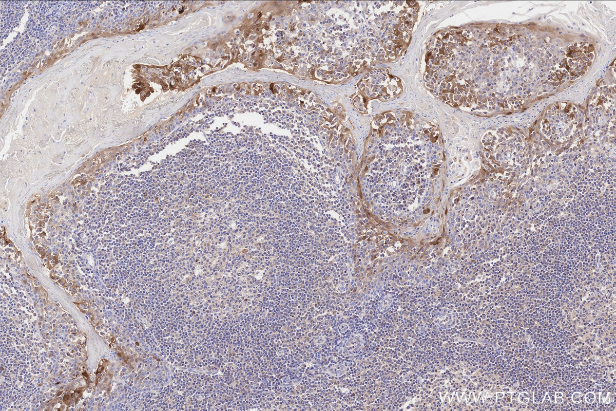 Immunohistochemistry (IHC) staining of human tonsillitis tissue using CDKN2A/P16-INK4A Monoclonal antibody (60626-1-Ig)