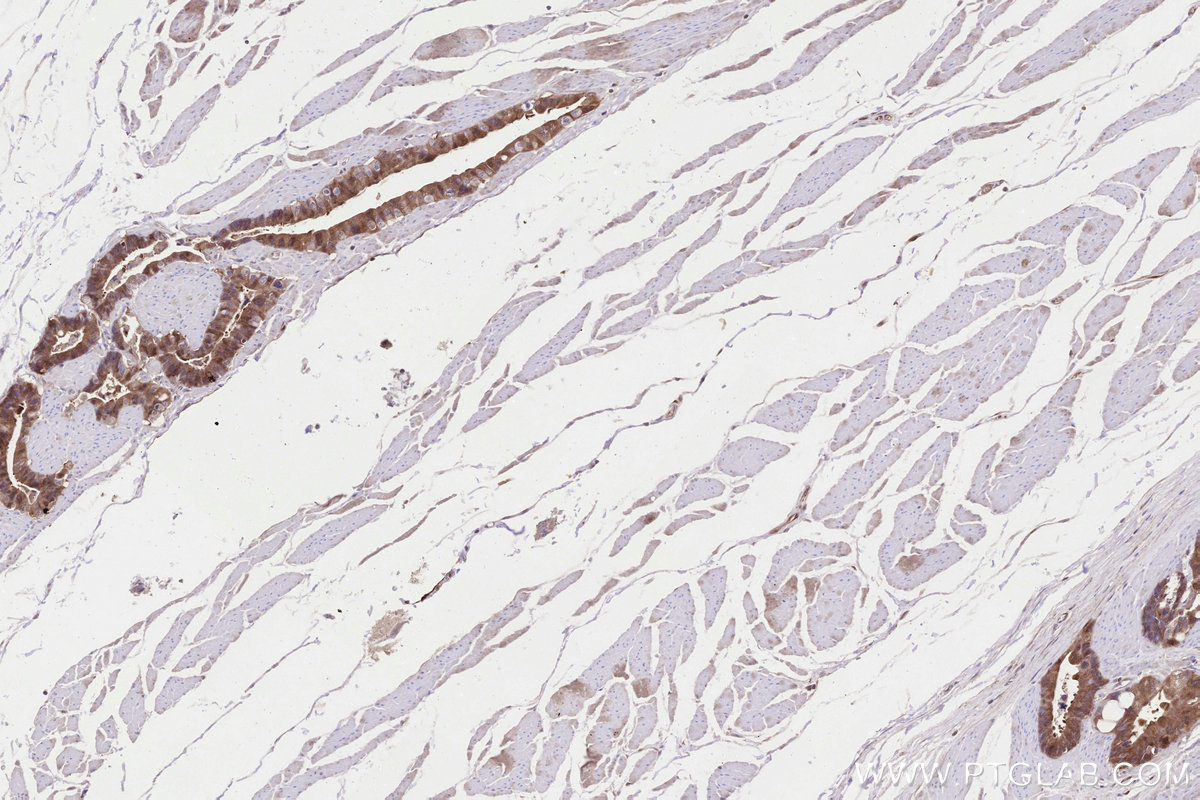 Immunohistochemistry (IHC) staining of human rectal cancer tissue using CDKN2A/P16-INK4A Monoclonal antibody (60626-1-Ig)