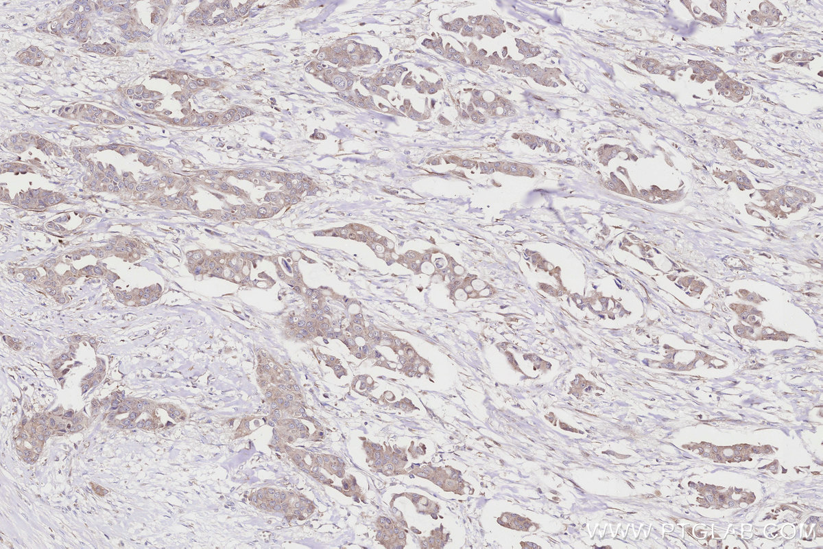 Immunohistochemistry (IHC) staining of Human Breast Cancer(Her2+;ER-;PR-) using CDKN2A/P16-INK4A Monoclonal antibody (60626-1-Ig)