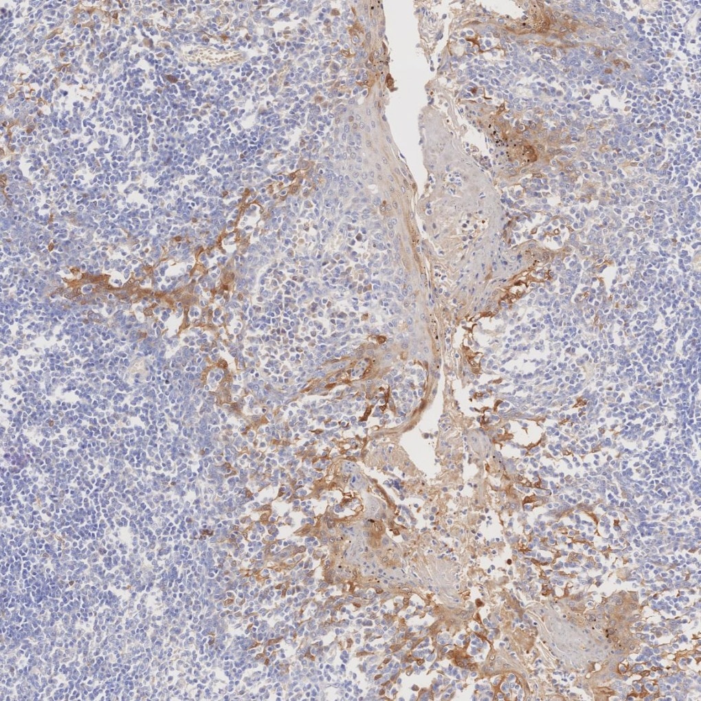IHC staining of human tonsillitis using 60626-1-Ig Immunohistochemistry (IHC) staining of human tonsillitis tissue using CDKN2A/P16-INK4A Monoclonal antibody (60626-1-Ig)