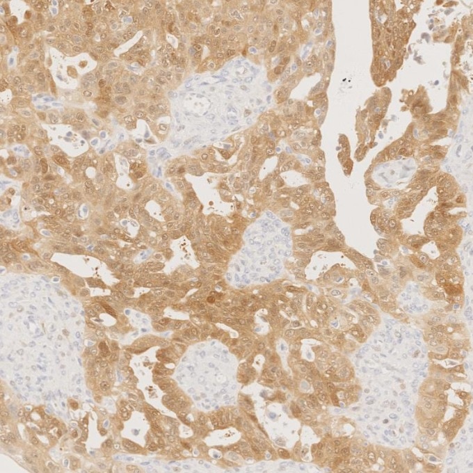 IHC staining of human ovary cancer using 60626-1-Ig Immunohistochemistry (IHC) staining of human ovary cancer tissue using CDKN2A/P16-INK4A Monoclonal antibody (60626-1-Ig)