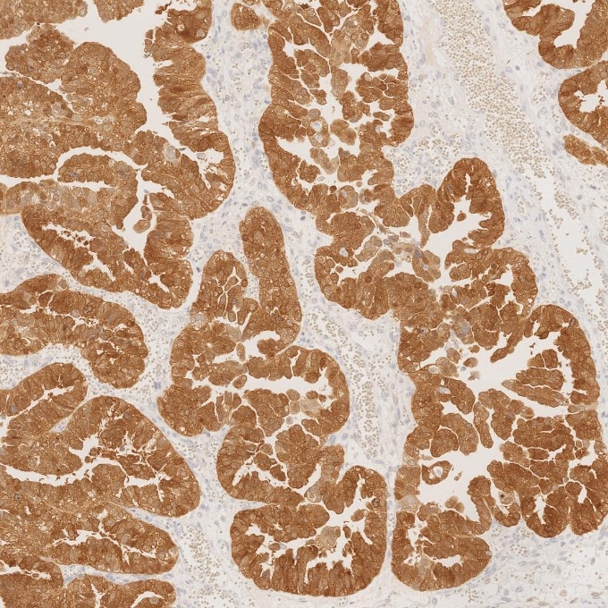 IHC staining of human ovary cancer using 60626-1-Ig Immunohistochemistry (IHC) staining of human ovary cancer tissue using CDKN2A/P16-INK4A Monoclonal antibody (60626-1-Ig)