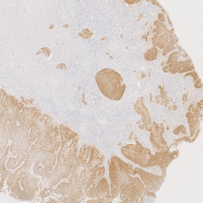 IHC staining of human cervical cancer using 60626-1-Ig Immunohistochemistry (IHC) staining of human cervical cancer tissue using CDKN2A/P16-INK4A Monoclonal antibody (60626-1-Ig)