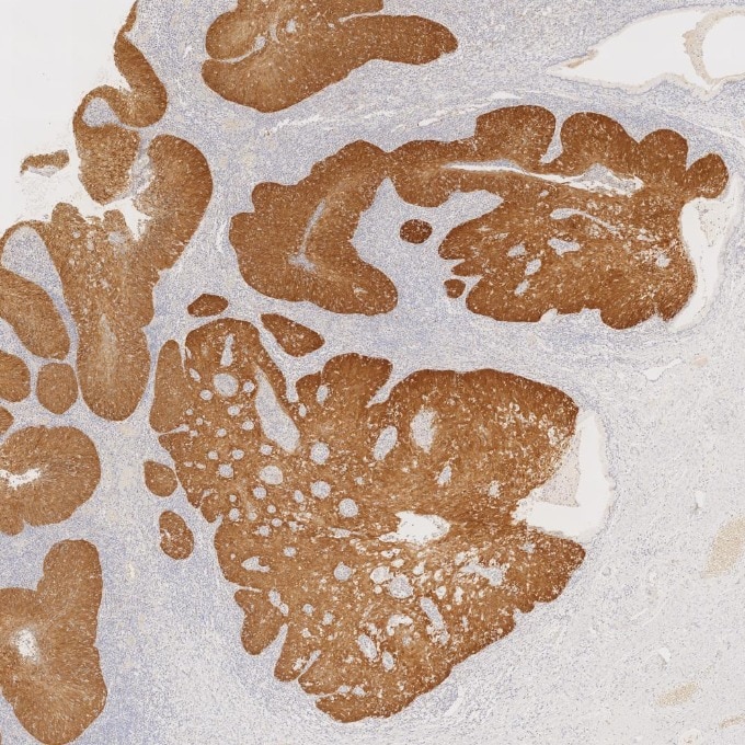 IHC staining of human cervical cancer using 60626-1-Ig Immunohistochemistry (IHC) staining of human cervical cancer tissue using CDKN2A/P16-INK4A Monoclonal antibody (60626-1-Ig)