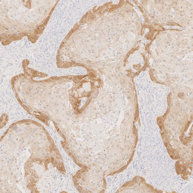 IHC staining of human cervical cancer using 60626-1-Ig Immunohistochemistry (IHC) staining of human cervical cancer tissue using CDKN2A/P16-INK4A Monoclonal antibody (60626-1-Ig)