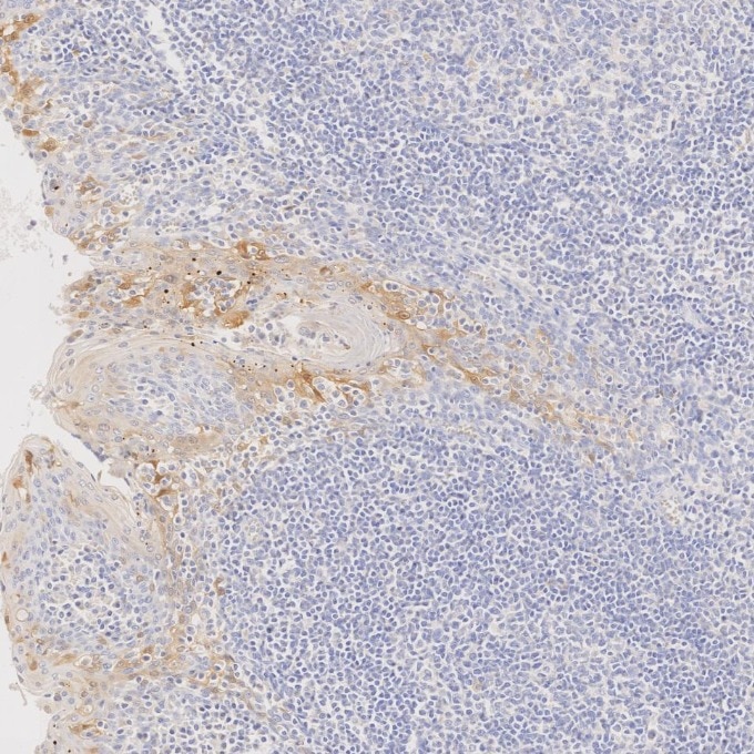 IHC staining of human tonsillitis using 60626-1-Ig Immunohistochemistry (IHC) staining of human tonsillitis tissue using CDKN2A/P16-INK4A Monoclonal antibody (60626-1-Ig)