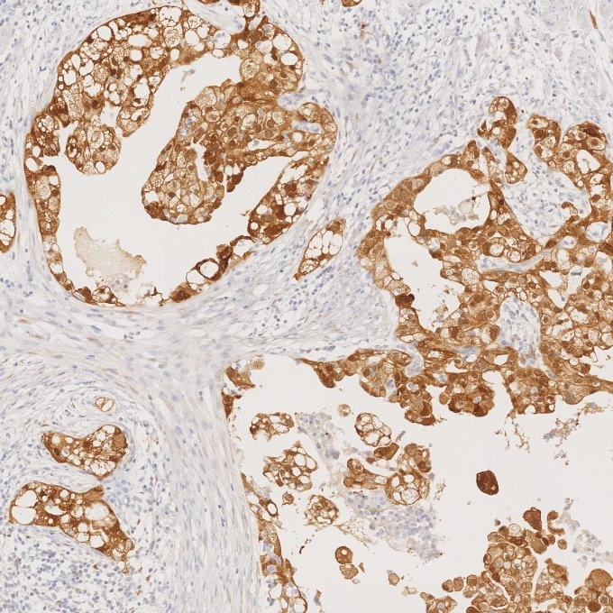 IHC staining of human ovary cancer using 60626-1-Ig Immunohistochemistry (IHC) staining of human ovary cancer tissue using CDKN2A/P16-INK4A Monoclonal antibody (60626-1-Ig)