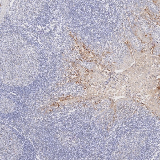 IHC staining of human tonsillitis using 60626-1-Ig Immunohistochemistry (IHC) staining of human tonsillitis tissue using CDKN2A/P16-INK4A Monoclonal antibody (60626-1-Ig)