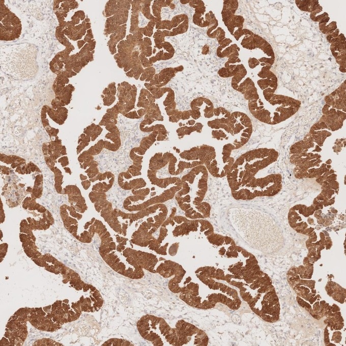 IHC staining of human ovary cancer using 60626-1-Ig Immunohistochemistry (IHC) staining of human ovary cancer tissue using CDKN2A/P16-INK4A Monoclonal antibody (60626-1-Ig)