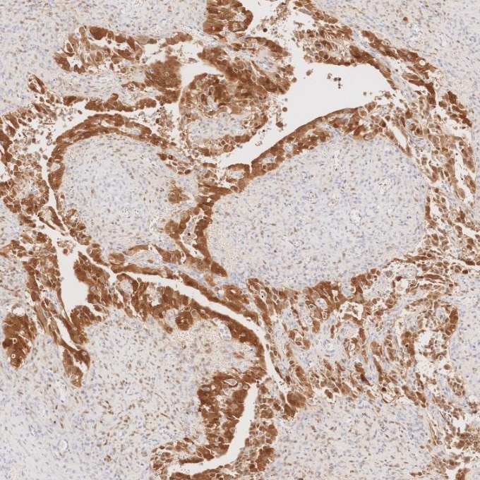 IHC staining of human ovary cancer using 60626-1-Ig Immunohistochemistry (IHC) staining of human ovary cancer tissue using CDKN2A/P16-INK4A Monoclonal antibody (60626-1-Ig)