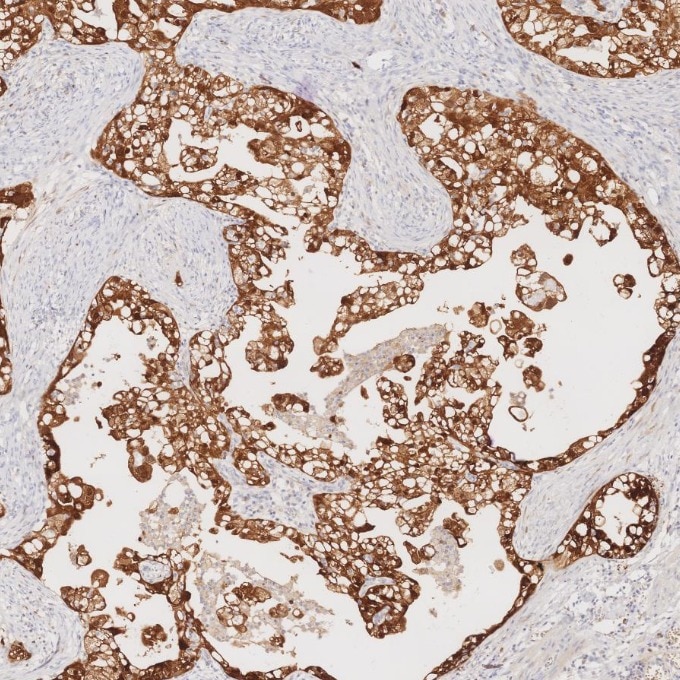 IHC staining of human ovary cancer using 60626-1-Ig Immunohistochemistry (IHC) staining of human ovary cancer tissue using CDKN2A/P16-INK4A Monoclonal antibody (60626-1-Ig)