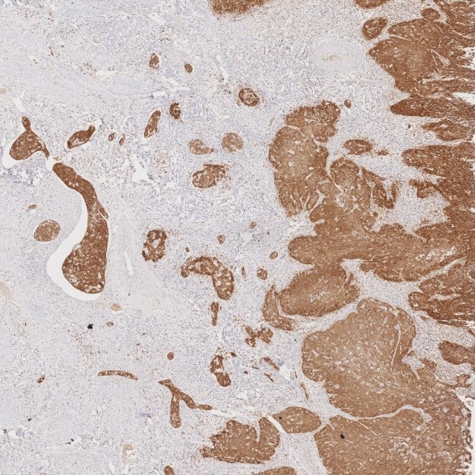 IHC staining of human cervical cancer using 60626-1-Ig Immunohistochemistry (IHC) staining of human cervical cancer tissue using CDKN2A/P16-INK4A Monoclonal antibody (60626-1-Ig)