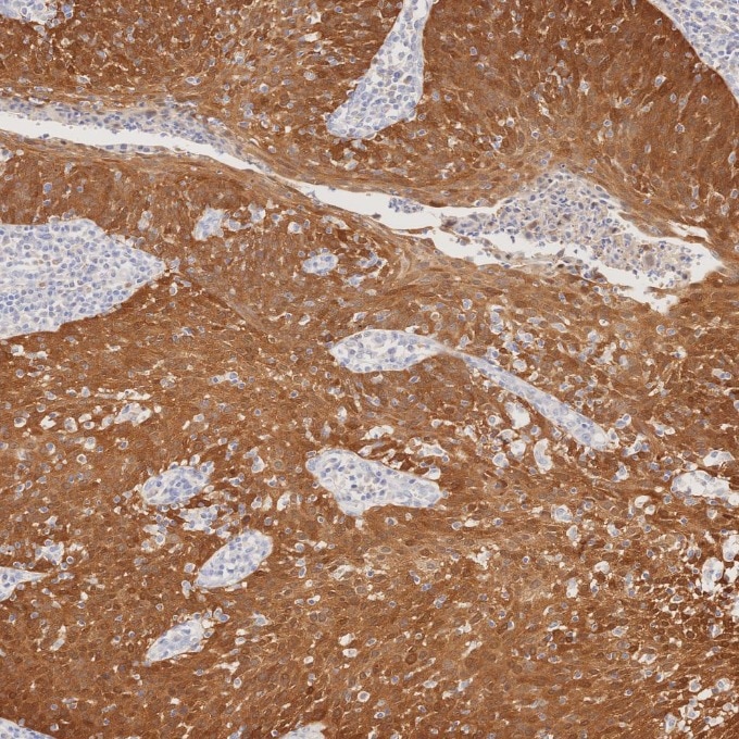 IHC staining of human cervical cancer using 60626-1-Ig Immunohistochemistry (IHC) staining of human cervical cancer tissue using CDKN2A/P16-INK4A Monoclonal antibody (60626-1-Ig)