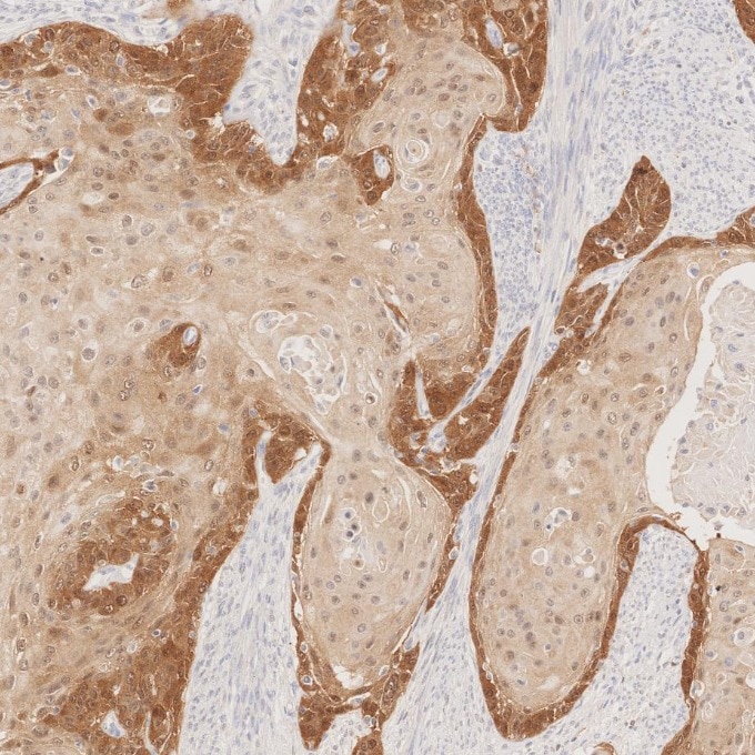 IHC staining of human cervical cancer using 60626-1-Ig Immunohistochemistry (IHC) staining of human cervical cancer tissue using CDKN2A/P16-INK4A Monoclonal antibody (60626-1-Ig)
